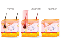 Waxing Brazil Brazilian Laser Haarentfernung